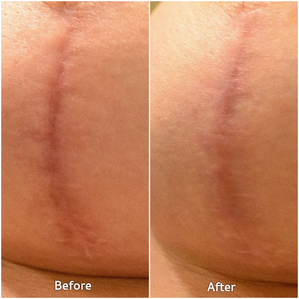 Lesley Murphy shows her before/after photos from Embrace Scar Therapy Treatment